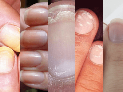 What Your Nails Can Say About Your&nbsp;Health